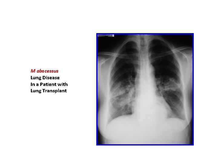 M abscessus Lung Disease In a Patient with Lung Transplant 