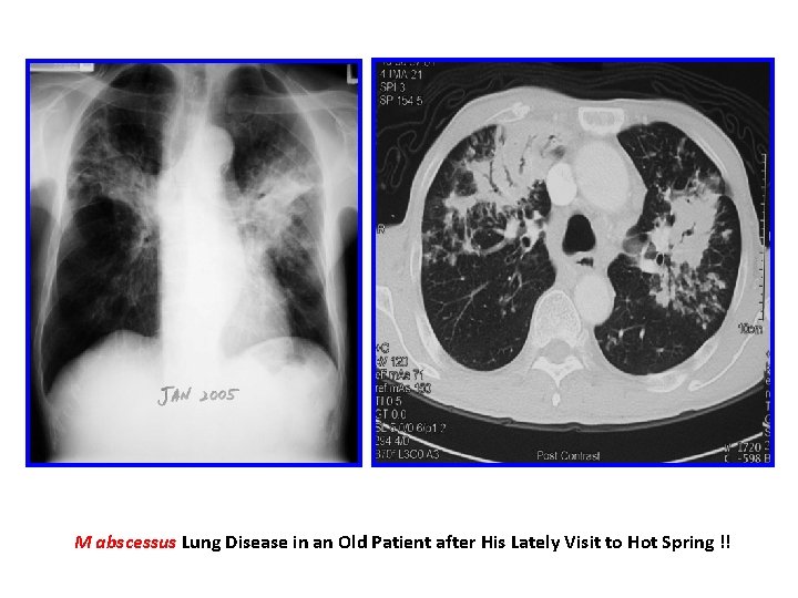M abscessus Lung Disease in an Old Patient after His Lately Visit to Hot