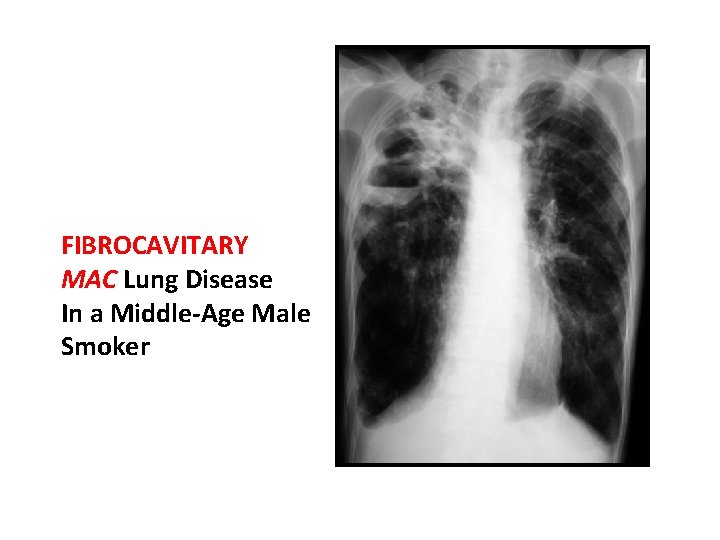 FIBROCAVITARY MAC Lung Disease In a Middle-Age Male Smoker 