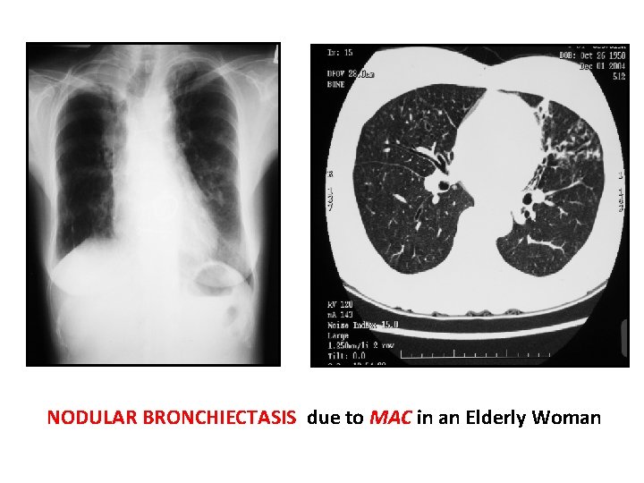 NODULAR BRONCHIECTASIS due to MAC in an Elderly Woman 