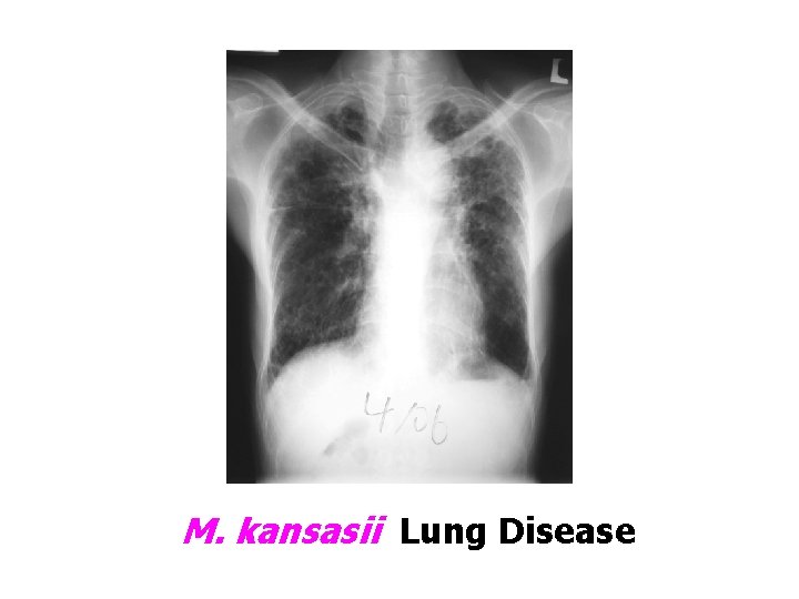 M. kansasii Lung Disease 