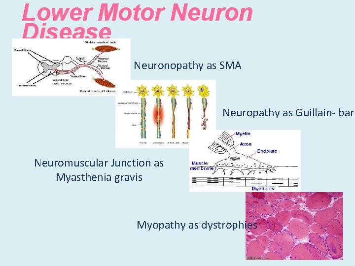Lower Motor Neuron Disease Neuronopathy as SMA Neuropathy as Guillain- barr Neuromuscular Junction as