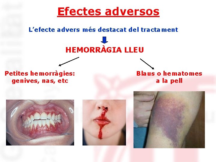 Efectes adversos L’efecte advers més destacat del tractament HEMORRÀGIA LLEU Petites hemorràgies: genives, nas,