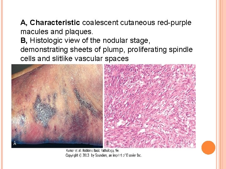 A, Characteristic coalescent cutaneous red-purple macules and plaques. B, Histologic view of the nodular