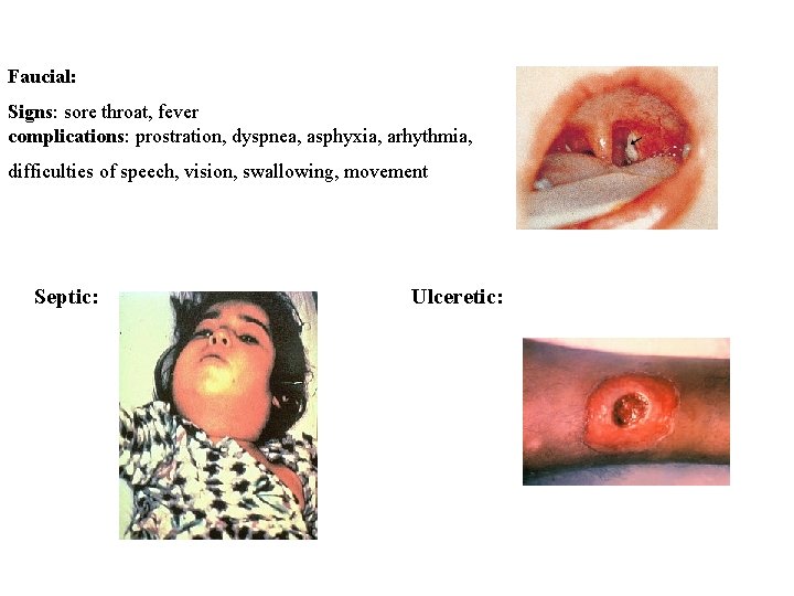 Faucial: Signs: sore throat, fever complications: prostration, dyspnea, asphyxia, arhythmia, difficulties of speech, vision,