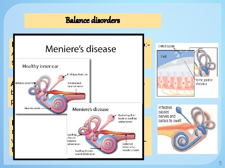 Balance disorders Benign paroxysmal positional vertigo: A change in head position causes a sudden
