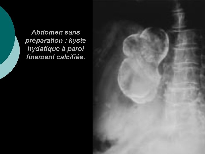 Abdomen sans préparation : kyste hydatique à paroi finement calcifiée. 