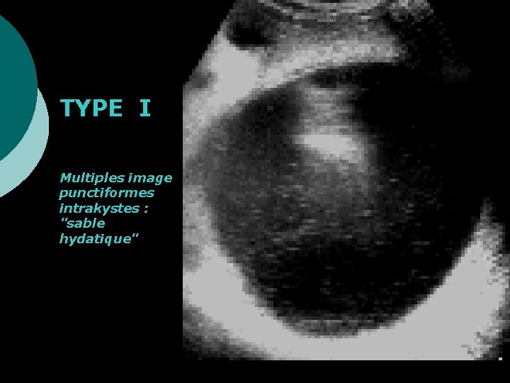 TYPE I Multiples image punctiformes intrakystes : "sable hydatique" 