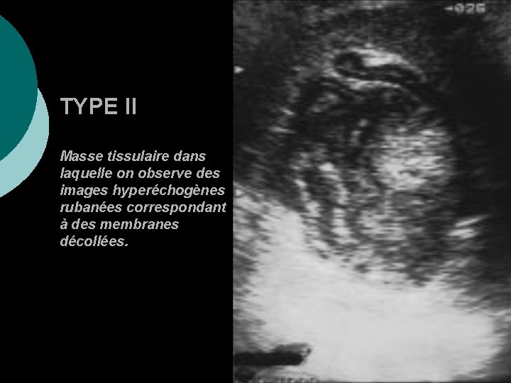 TYPE II Masse tissulaire dans laquelle on observe des images hyperéchogènes rubanées correspondant à