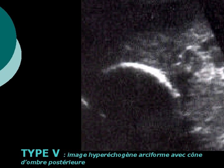 TYPE V : image hyperéchogène arciforme avec cône d’ombre postérieure 