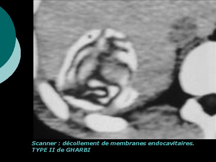 Scanner : décollement de membranes endocavitaires. TYPE II de GHARBI 
