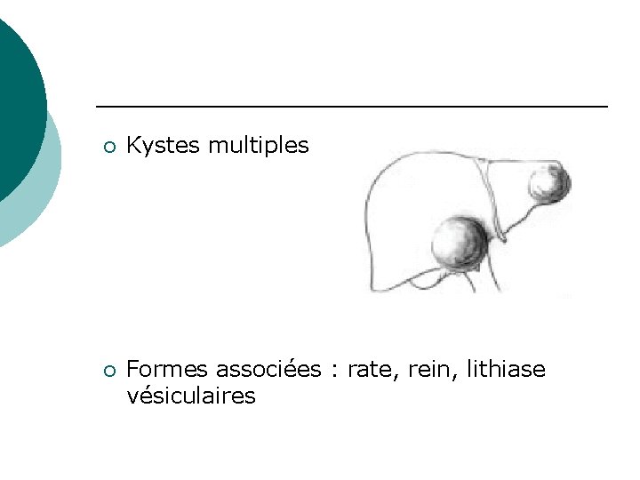 ¡ Kystes multiples ¡ Formes associées : rate, rein, lithiase vésiculaires 