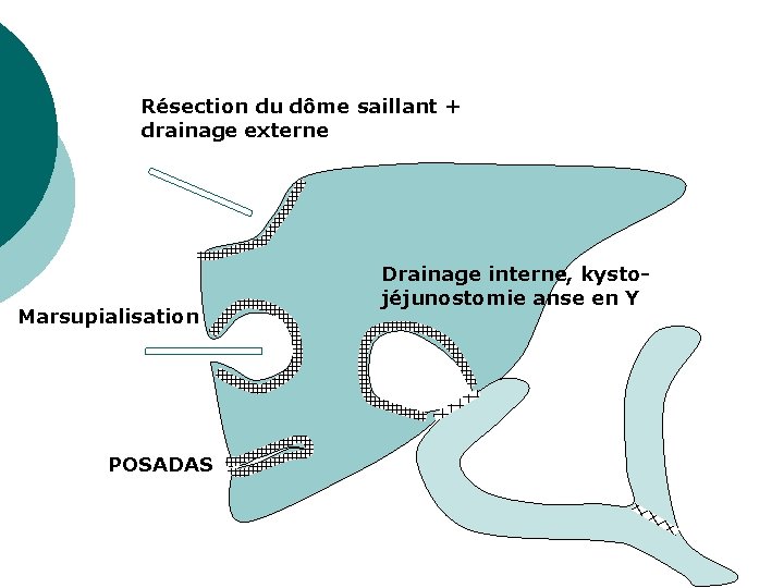 Résection du dôme saillant + drainage externe Marsupialisation POSADAS Drainage interne, kystojéjunostomie anse en