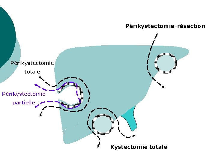 Périkystectomie-résection Périkystectomie totale Périkystectomie partielle Kystectomie totale 