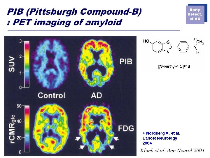 CN-17 + Nordberg A. et al. Lancet Neurology 2004 