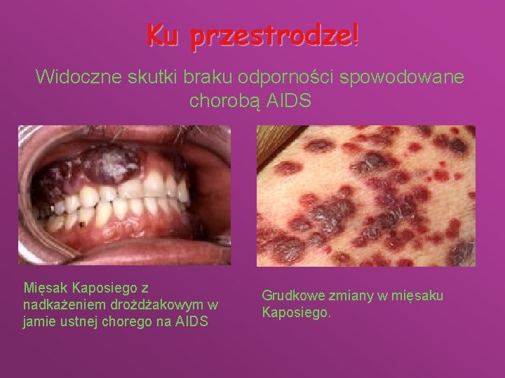 Ku przestrodze! Widoczne skutki braku odporności spowodowane chorobą AIDS Mięsak Kaposiego z nadkażeniem drożdżakowym
