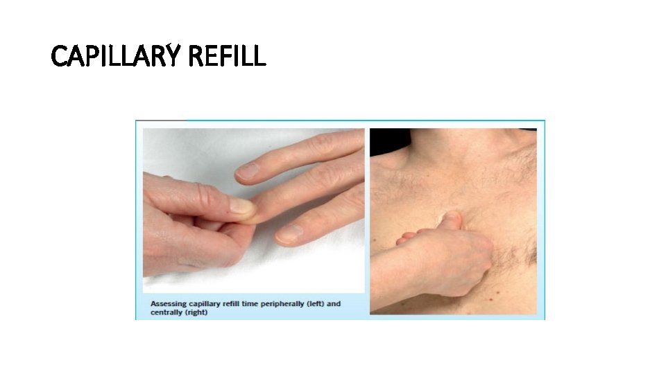 CAPILLARY REFILL 