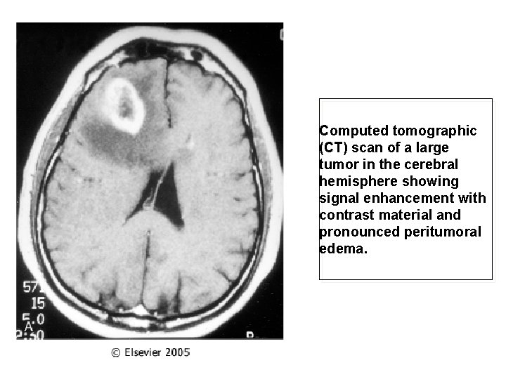 Computed tomographic (CT) scan of a large tumor in the cerebral hemisphere showing signal