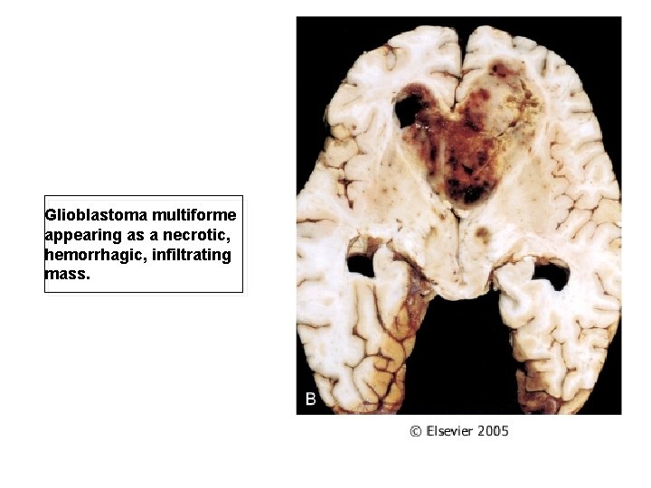 Glioblastoma multiforme appearing as a necrotic, hemorrhagic, infiltrating mass. 