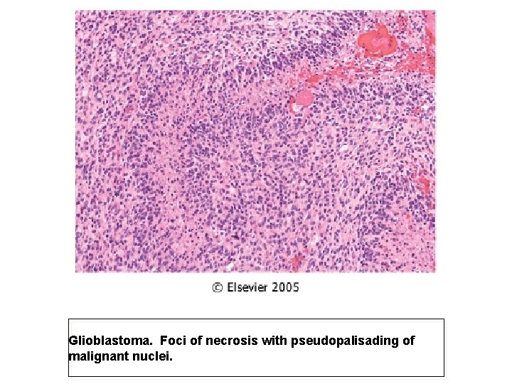 Glioblastoma. Foci of necrosis with pseudopalisading of malignant nuclei. 