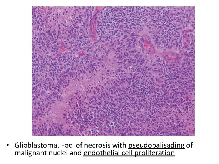  • Glioblastoma. Foci of necrosis with pseudopalisading of malignant nuclei and endothelial cell