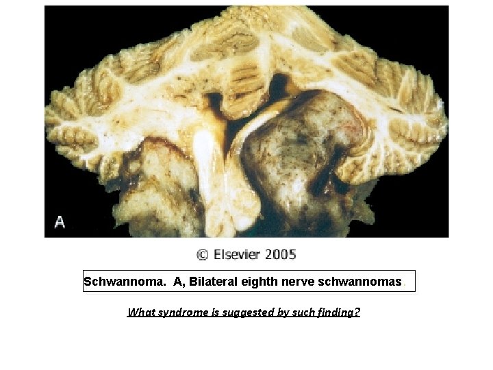 Schwannoma. A, Bilateral eighth nerve schwannomas. What syndrome is suggested by such finding? 