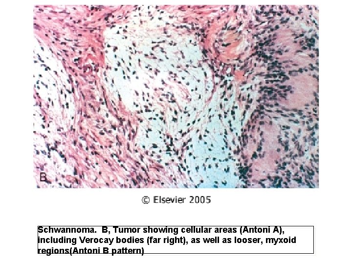 Schwannoma. B, Tumor showing cellular areas (Antoni A), including Verocay bodies (far right), as