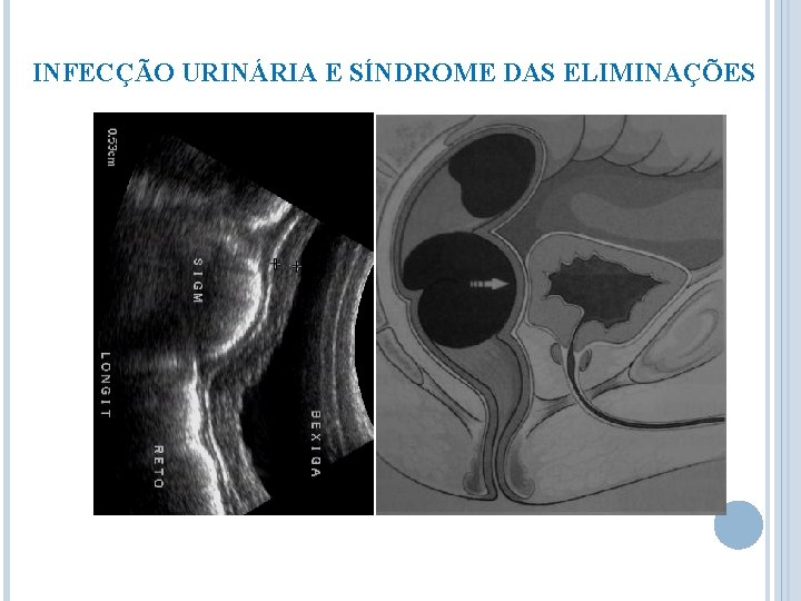 INFECÇÃO URINÁRIA E SÍNDROME DAS ELIMINAÇÕES 