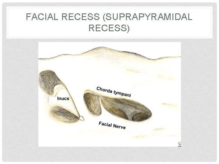 FACIAL RECESS (SUPRAPYRAMIDAL RECESS) 