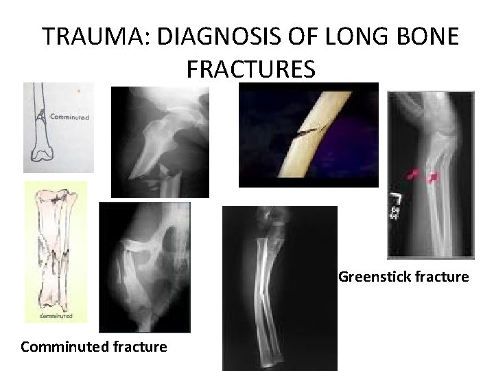 TRAUMA: DIAGNOSIS OF LONG BONE FRACTURES Greenstick fracture Comminuted fracture 