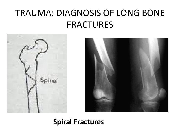 TRAUMA: DIAGNOSIS OF LONG BONE FRACTURES Spiral Fractures 