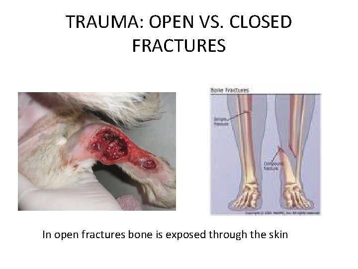 TRAUMA: OPEN VS. CLOSED FRACTURES In open fractures bone is exposed through the skin
