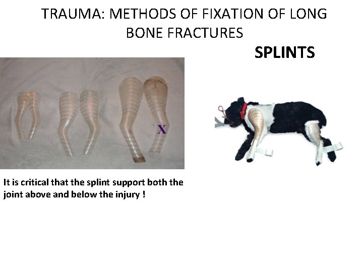TRAUMA: METHODS OF FIXATION OF LONG BONE FRACTURES SPLINTS It is critical that the