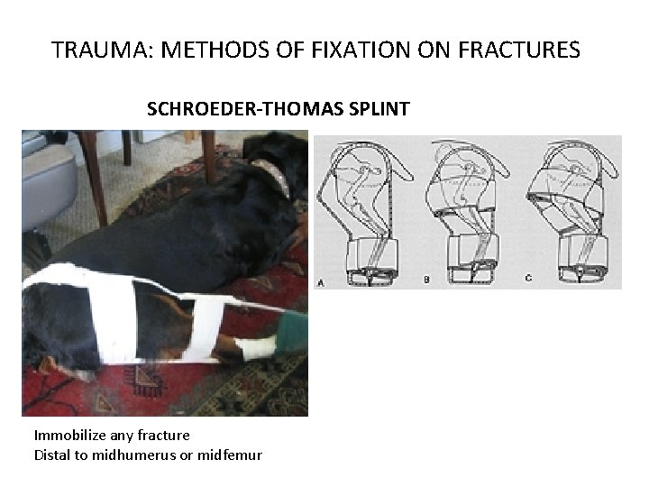 TRAUMA: METHODS OF FIXATION ON FRACTURES SCHROEDER-THOMAS SPLINT Immobilize any fracture Distal to midhumerus