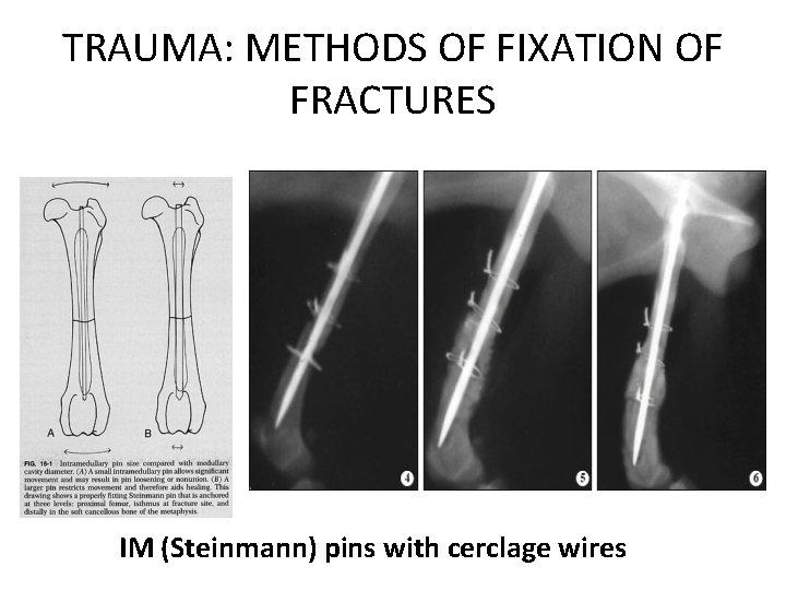 TRAUMA: METHODS OF FIXATION OF FRACTURES IM (Steinmann) pins with cerclage wires 