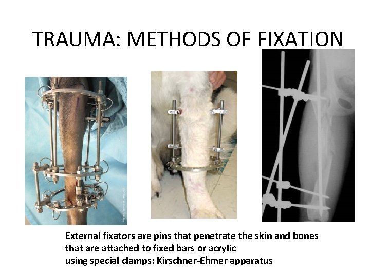 TRAUMA: METHODS OF FIXATION External fixators are pins that penetrate the skin and bones