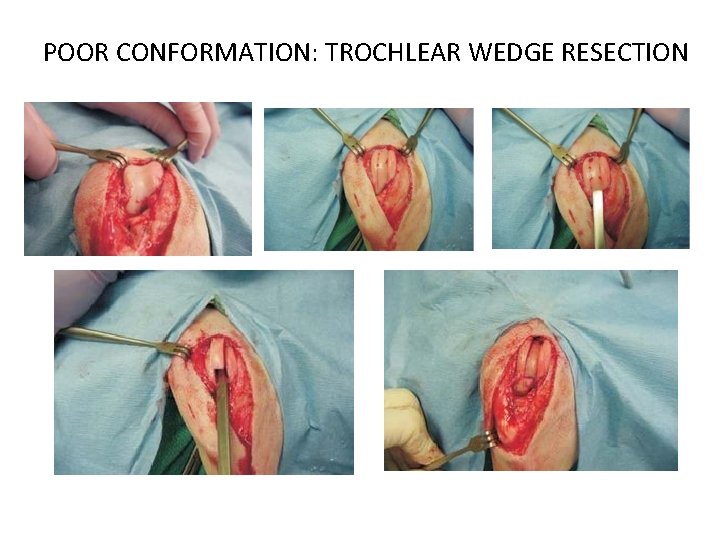 POOR CONFORMATION: TROCHLEAR WEDGE RESECTION 