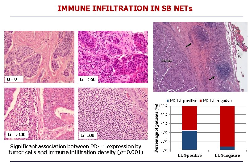 IMMUNE INFILTRATION IN SB NETs Tumor Li= 0 Li= >50 Li= >100 Li=500 Significant