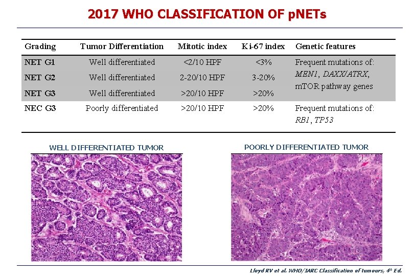 2017 WHO CLASSIFICATION OF p. NETs Grading Tumor Differentiation Mitotic index Ki-67 index NET