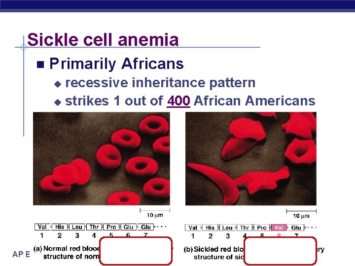 Sickle cell anemia n Primarily Africans recessive inheritance pattern u strikes 1 out of