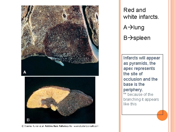 Red and white infarcts. A lung B spleen Infarcts will appear as pyramids, the