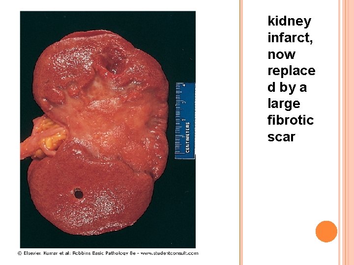 kidney infarct, now replace d by a large fibrotic scar 