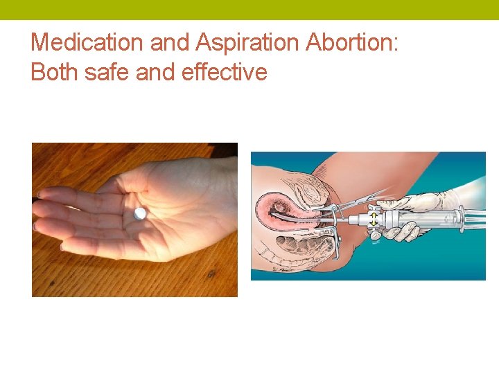 Medication and Aspiration Abortion: Both safe and effective 