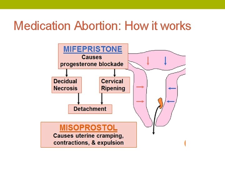 Medication Abortion: How it works 