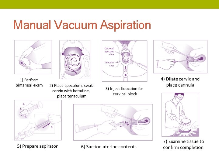 Manual Vacuum Aspiration 