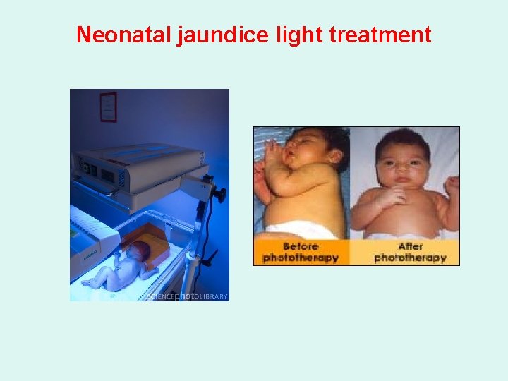 Neonatal jaundice light treatment 