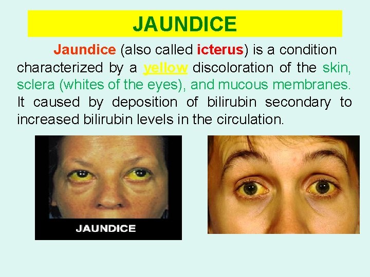 JAUNDICE Jaundice (also called icterus) is a condition characterized by a yellow discoloration of