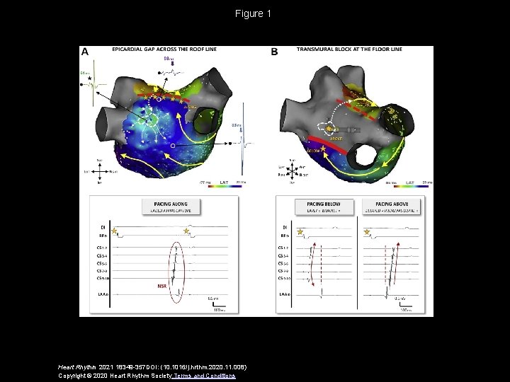 Figure 1 Heart Rhythm 2021 18349 -357 DOI: (10. 1016/j. hrthm. 2020. 11. 008)