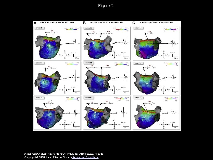 Figure 2 Heart Rhythm 2021 18349 -357 DOI: (10. 1016/j. hrthm. 2020. 11. 008)