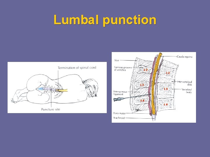 Lumbal punction 